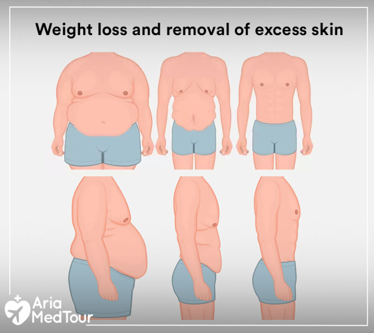 Excess Skin after Weight Loss Surgery Why and How to Manage